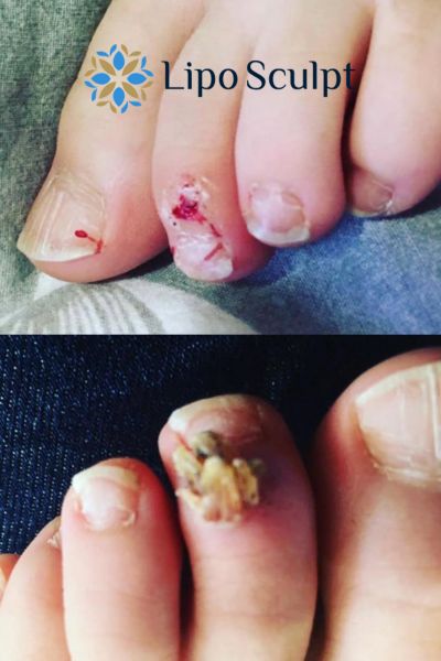 Wart removal customer results from Lipo Sculpt Broadstone